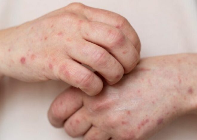 Adolescente contrae sarampión en Santiago Atitlán y lleva la enfermedad a la capital