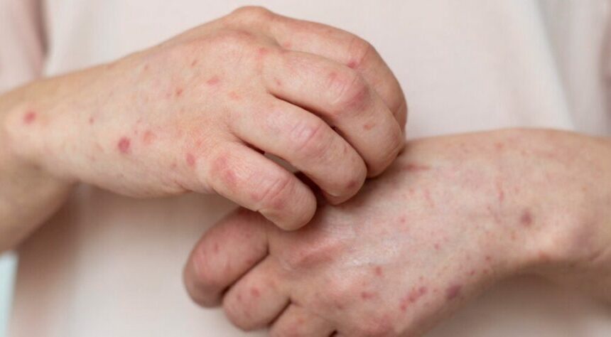 Adolescente contrae sarampión en Santiago Atitlán y lleva la enfermedad a la capital